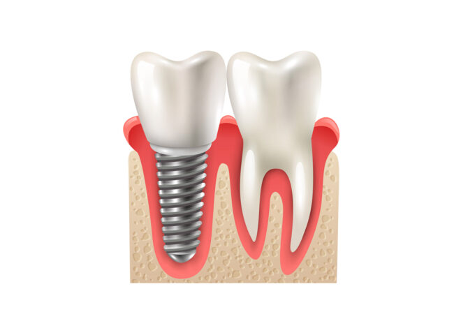 İmplant Tedavisi ve Fiyatları Hakkında Detaylı Rehber