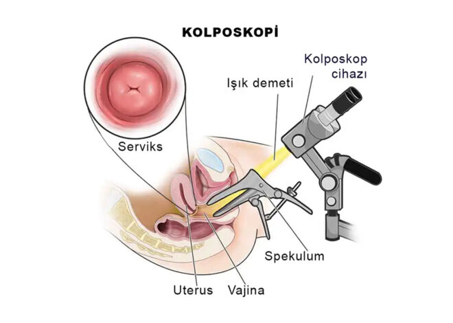 Kolposkopi Nedir? Rahim Ağzı Sağlığı İçin Neden Önemlidir?