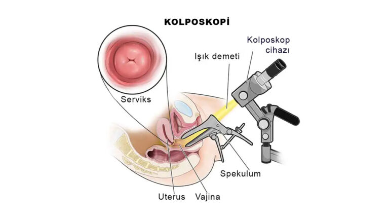 Kolposkopi Nedir? Rahim Ağzı Sağlığı İçin Neden Önemlidir?