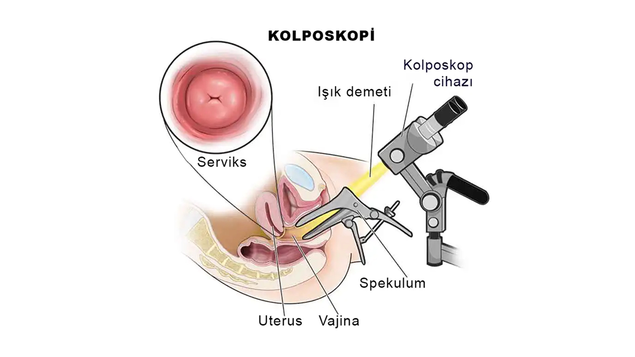 Kolposkopi Nedir? Rahim Ağzı Sağlığı İçin Neden Önemlidir?